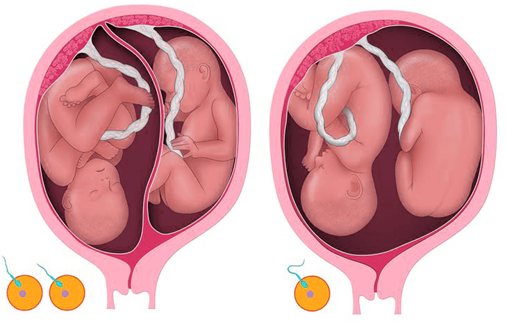مراحل نمو الجنين التوأم بالأسابيع بالصور هل انت حامل بالتوأم إبحث