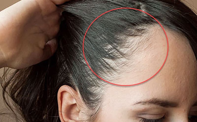 علاج فراغات الشعر الأمامية للنساء