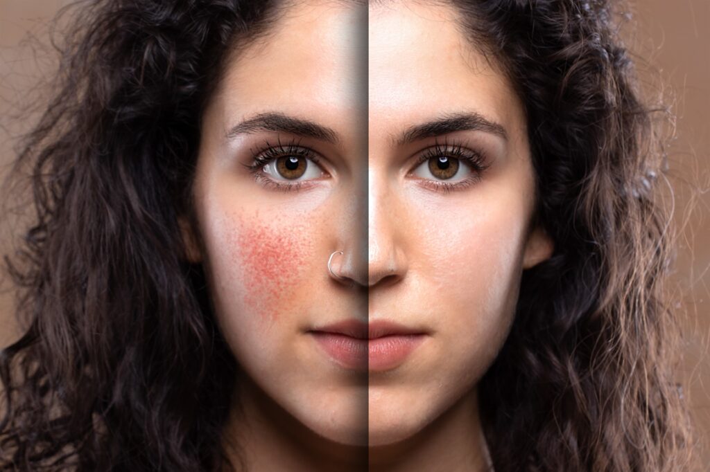 علاج التهاب الوجه واحمراره بالطرق الطبيعية 